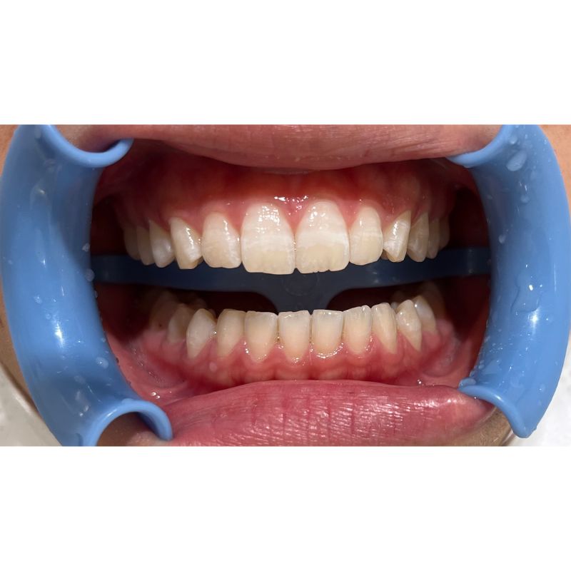 ホワイトニング症例 After