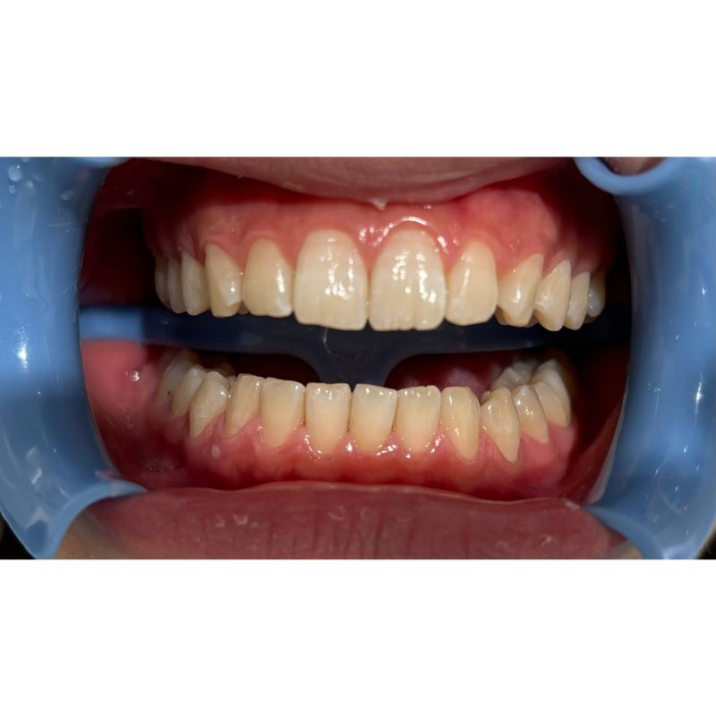 ホワイトニング症例 Before